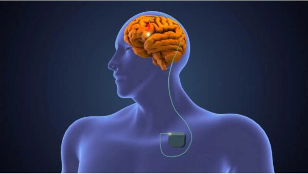 Depression may be Safely Alleviated at home Using Brain Stimulation Therapy